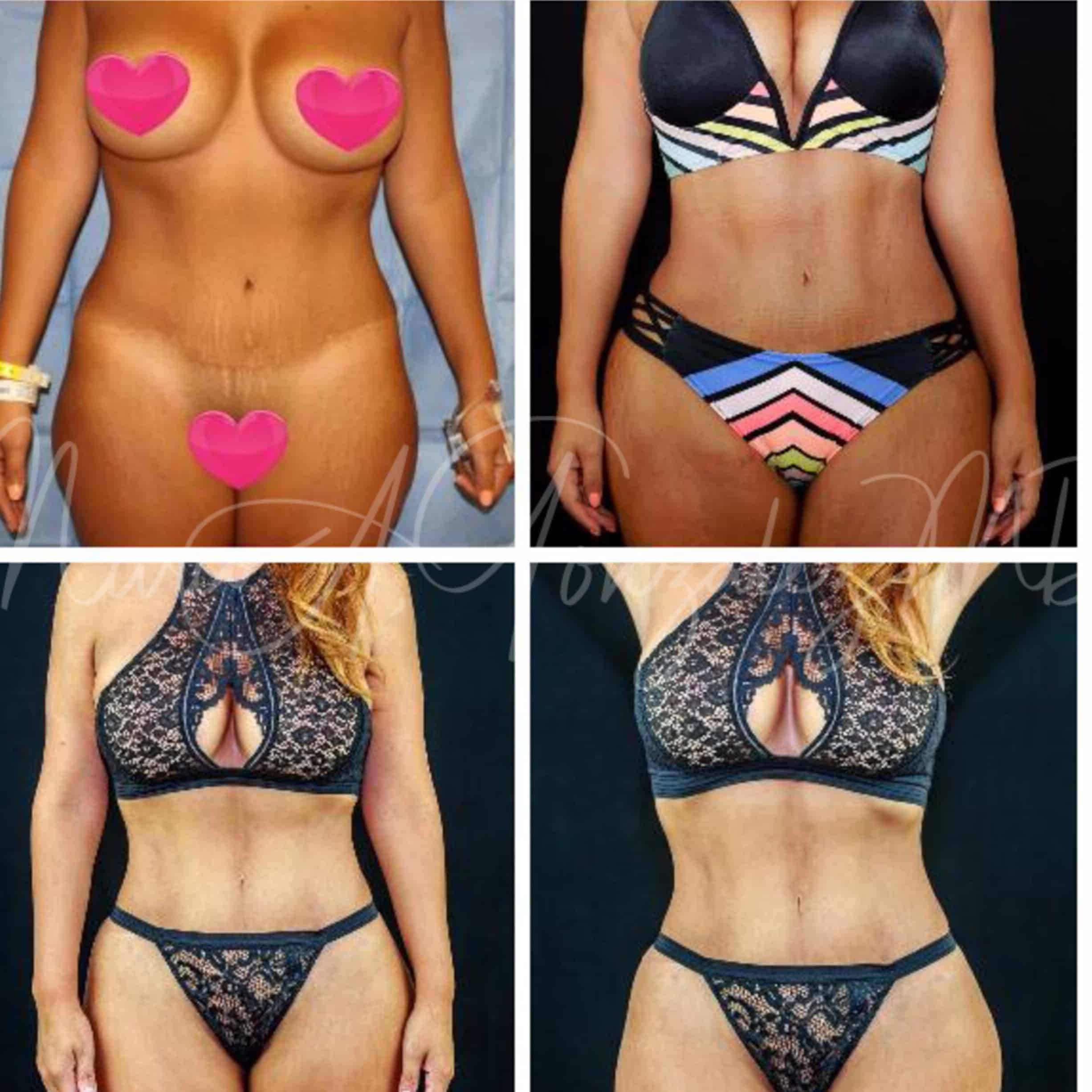 Case--8629 | Before Brazilian Butt Lift