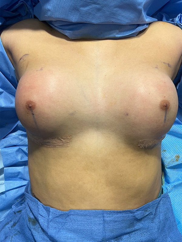 Case--5309 | After Transgender Breast Augmentation