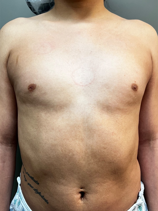 Case--5309 | Before Transgender Breast Augmentation