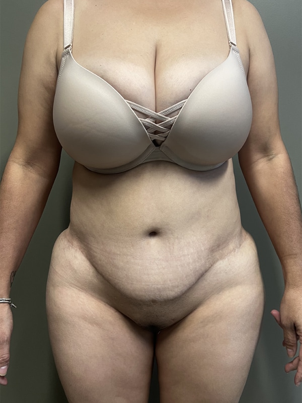 Case--7292 | After Body