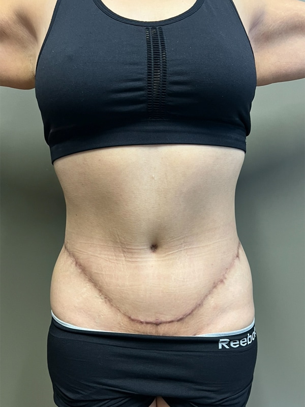 Case--8870 | After Body